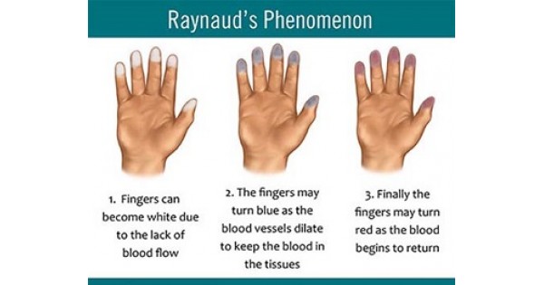 Sindromul Raynaud