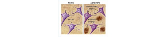 Tratament Boala Alzheimer
