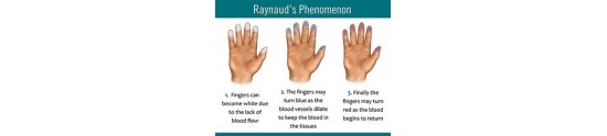 Sindromul Raynaud