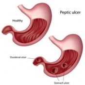 Ulcer Gastric si Duodenal