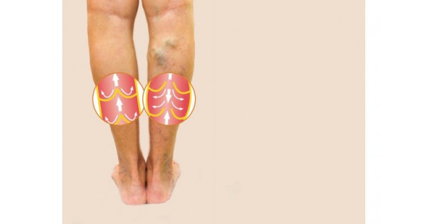 primele simptome ale picioarelor varicoase odintsovo varicoza